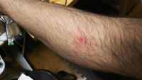 2018 may left leg zit 0259