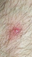 2018 may left leg zit 0260