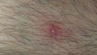 2018 may left leg zit 0261