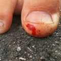 2019 jul 20 bloody stubbed big toe on asphalt