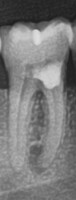 2024 mar 13 abcess dead tooth xray