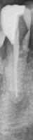 2024 mar 13 abcess root canal xray