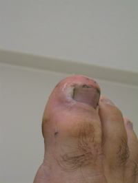 ingrown toenail removal - 1