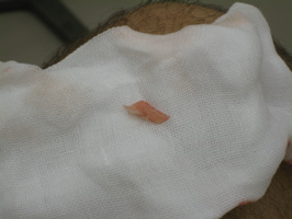 ingrown toenail removal - 5
