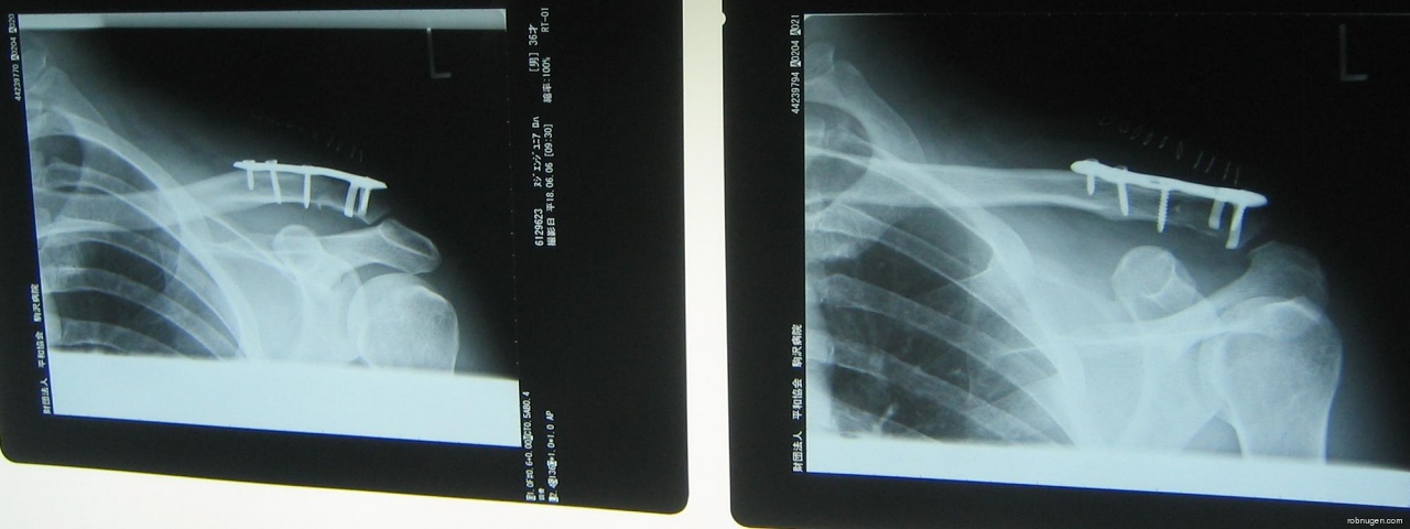 clavicle X-ray with plate