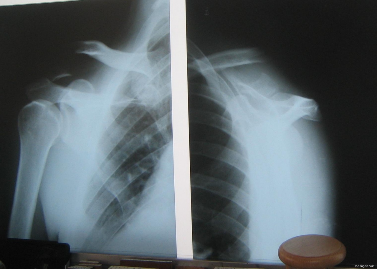 clavicle X-rays showing vertical displacement