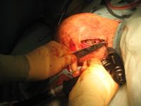 clavicle surgery: during - 15:35pm